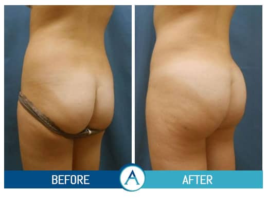 Liposuction Back and Flanks Treatment Gallery in New Bern, NC