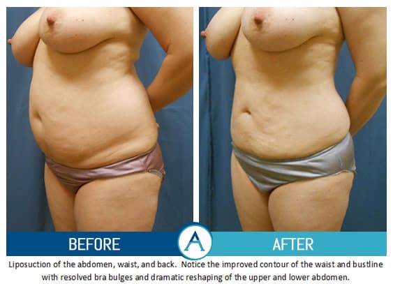 Liposuction Back and Flanks Treatment Gallery in New Bern, NC