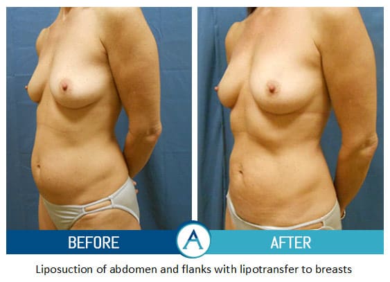 Liposuction - Abdomen / Flanks Before and After Pictures Case 14, Coeur  d'Alene, ID