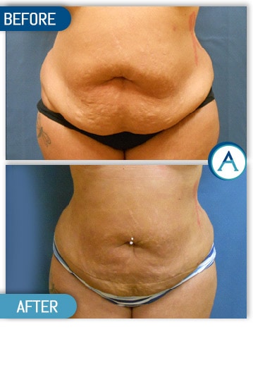 Liposuction Back and Flanks Treatment Gallery in New Bern, NC