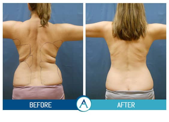 Liposuction of Flanks Before and After 3804