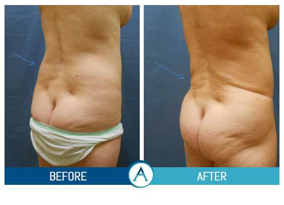 Liposuction of Flanks Before and After 3804