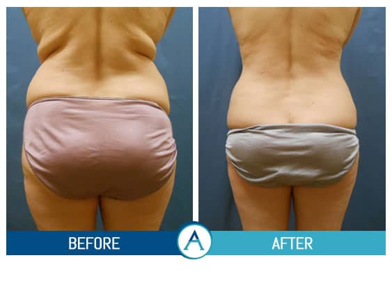 Liposuction of Flanks Before and After 3804