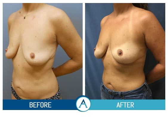 Scarless Breast Reduction - Is Breast Liposuction Effective