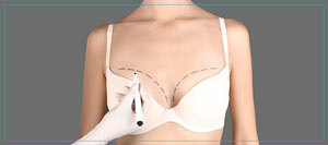 Breast Reduction Procedure Specialist Near Me in New Bern, NC Breast Reduction Procedure Specialist Near Me in New Bern, NC