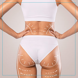 Fat Transfers Buttocks Treatment Before & After Gallery in New Bern, NC