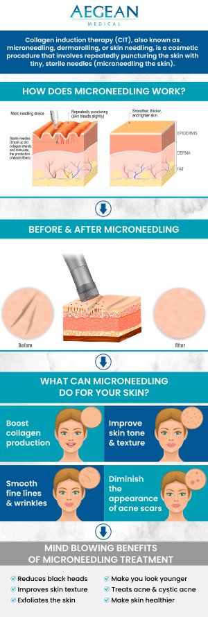 If you want to improve, firm, and rejuvenate your skin, Aegean Medical has the right treatment for you. Microneedling is a minimally invasive cosmetic procedure that's used to treat skin concerns by stimulating collagen production. Contact us or visit us online to book an appointment. We are conveniently located at 2111 Neuse Blvd, Suite J, New Bern, NC 28560.